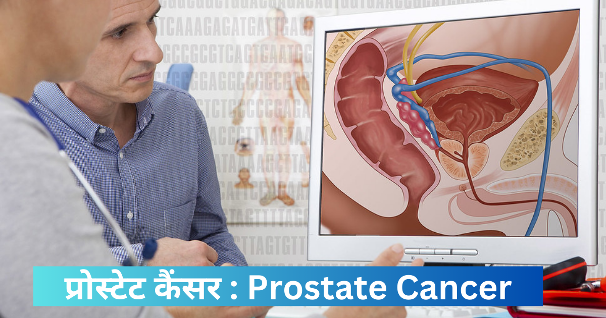 प्रोस्टेट कैंसर : Prostate Cancer